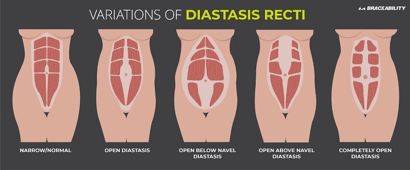 diastasis-recto-variations-abdominal-separations